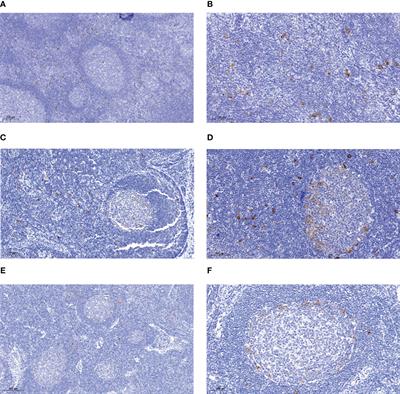 Clonal composition and differentiation stage of human CD30+ B cells in reactive lymph nodes